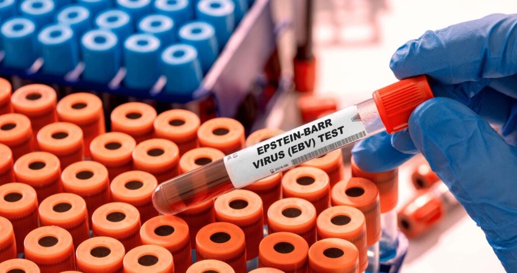 Gloved hand holding test tube that says "Epstein-Barr Virus (EBV) Test" hovering over racks of test tubes